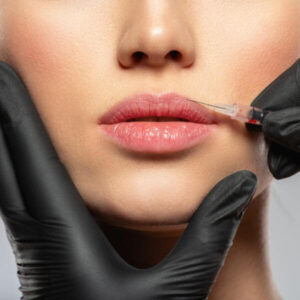 botox cheek filler lumident (2)