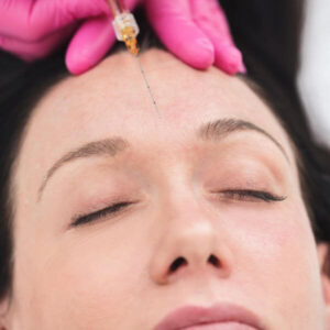 botox cheek filler lumident (6)