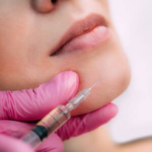 botox cheek filler lumident (8)