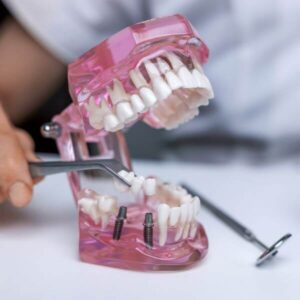 dental Implant