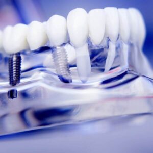 implante dental